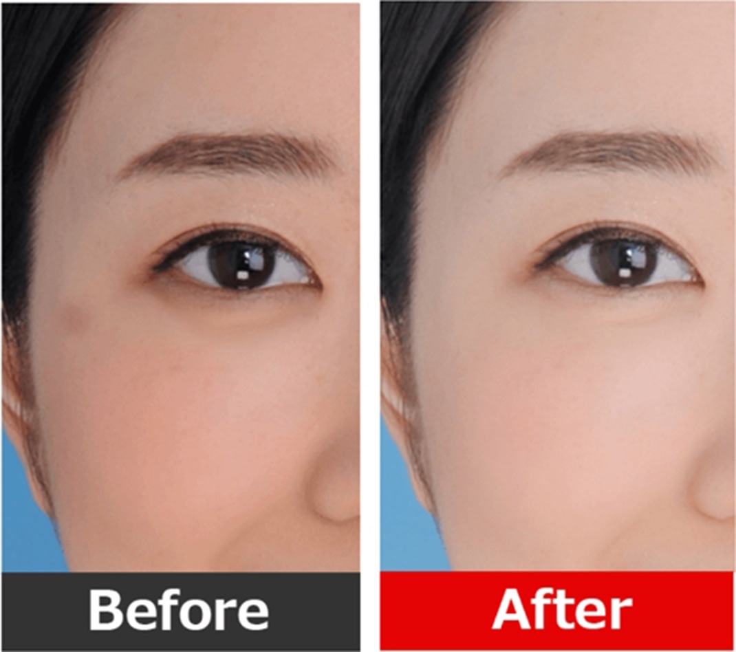美肌修正 Before After